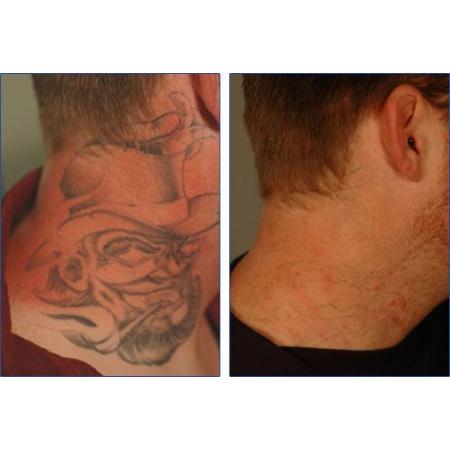 Tattoo Cost Canberra | canberra tattoo removal tattoo removal 73 anthony Tattoo Cost Canberra | canberra tattoo removal tattoo removal 73 anthony