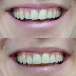 Instead of braces to shift the teeth, resin was added to give a straight appearance.