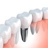 Braddon Dental Surgery - Pic 5