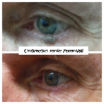 Cosmetic Mole Removed from centre of lower using Electro surgical technique with minimal scarring from $180
