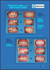 Ortho Before & After Photos