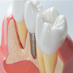 Dr Yang & Dr Kim offer complete dental implant treatment.
