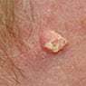 Port Macquarie Skin Cancer Clinic - Pic 8