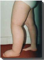 Lymphoedema Clinic Adelaide - Pic 1