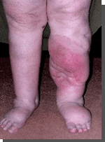 Lymphoedema Clinic Adelaide - Pic 2