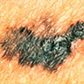 Port Macquarie Skin Cancer Clinic - Pic 6