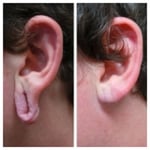 Price guide:  From $400-$600 per earlobe depending on work involved. There is a small medicare rebate.
