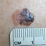 Port Macquarie Skin Cancer Clinic - Pic 9