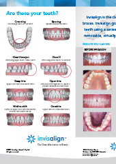 Invisalign