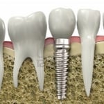 Implant replacement of missing tooth.