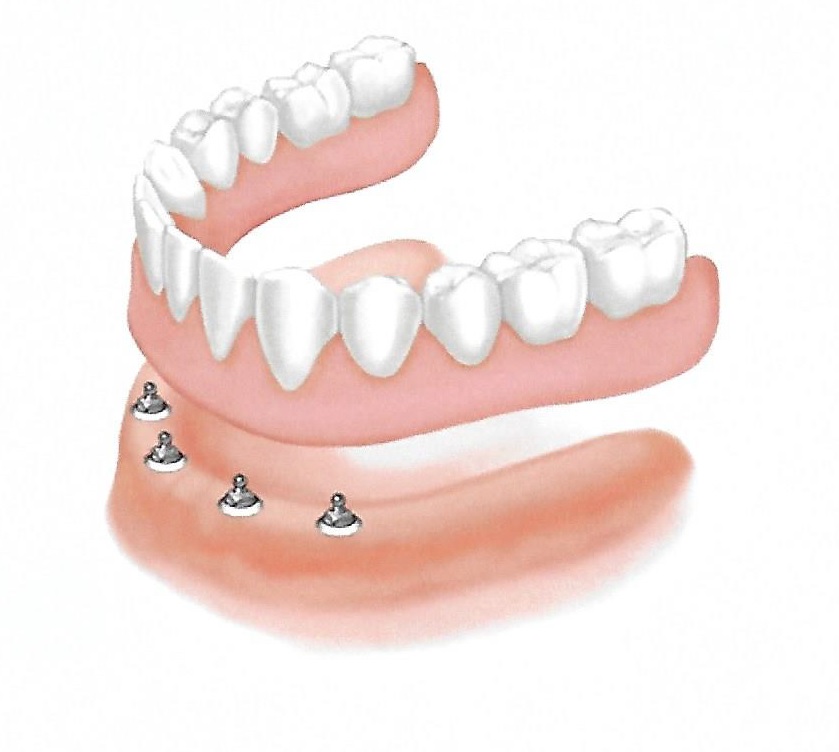 Cosmetic Denture Services Dental Prosthetist Mackay Yellow Pages®