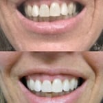 Superior results achieved with the take home whitening gel kit. Single visit options also available.