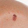 Port Macquarie Skin Cancer Clinic - Pic 1