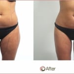 This is a before and after image of a patient who underwent Vaser Liposuction on her Thighs, Tummy and Flanks.
