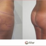 This is a before and after image of a patient who underwent a Butt Augmentation