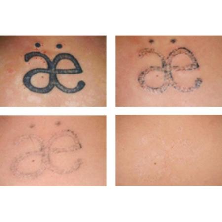 Tattoo Prices Canberra | canberra tattoo removal tattoo removal 73 anthony Tattoo Prices Canberra | canberra tattoo removal tattoo removal 73 anthony