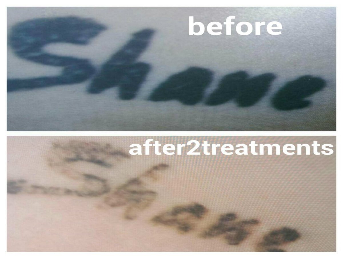 laser pro tattoo removal tattoo removal albion park laser pro tattoo removal tattoo removal albion park