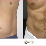 This is a before and after image of a patient who underwent Vaser Hi Definition Liposuction